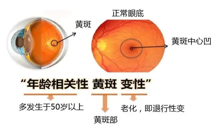 全国55家公立三甲医院招募“湿性年龄相关性黄斑变性”患者@北京协和医院　@雷珠单抗注射液治疗一年