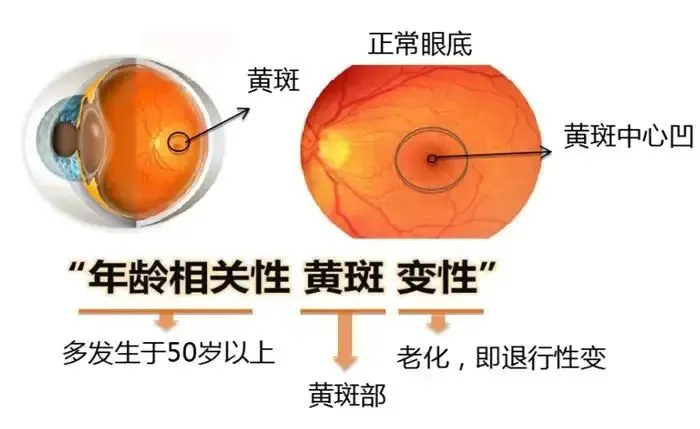 招募黄斑变性患者@首都医科大学附属北京同仁医院及全国36家医院 I 免费雷珠单抗治疗1年