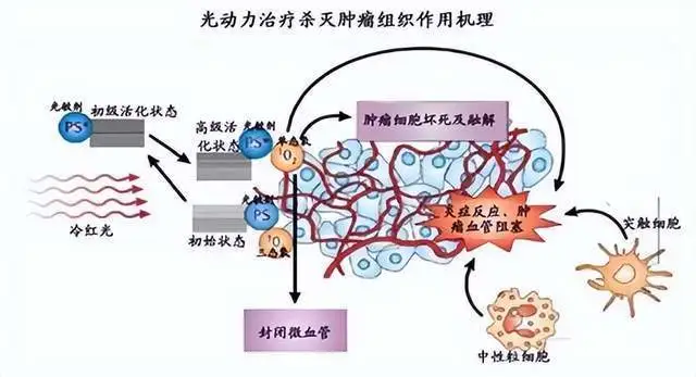 招募食管癌患者@北京肿瘤医院及全国22家医院 I 国内唯一且最早进入肿瘤PDT治疗临床研究&注射用华卟啉钠