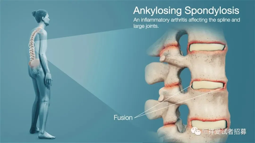 招募强直性脊柱炎@中国医学科学院北京协和医院及全国43家参研医院 免费治疗